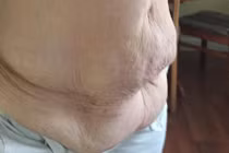 Tận mục cơ thể nhăn nhúm phát sợ do giảm cân quá nhiều