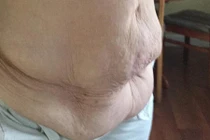 Tận mục cơ thể nhăn nhúm phát sợ do giảm cân quá nhiều