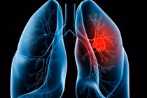 Ung thư phổi ở đàn ông và đàn bà khác nhau thế nào?
