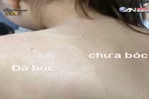 Mê trận lột da tắm trắng siêu tốc giá bèo hút teen Việt