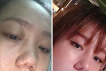 Cô gái tố bị hỏng mũi, trầm cảm sau khi nâng mũi tại thẩm mỹ viện Klain Beauty Center