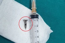 Đinh vít 1,5cm găm vào phế quản bé 22 tháng tuổi