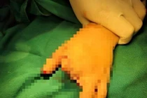 Cấp cứu làm mỏm cụt cho người phụ nữ dập bàn tay vì máy xay thịt