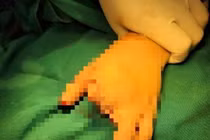 Cấp cứu làm mỏm cụt cho người phụ nữ dập bàn tay vì máy xay thịt