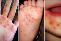 Bệnh Tay chân miệng vào mùa, phụ huynh cần biết gì để bảo vệ con?