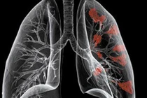 Những điều không nên bỏ qua về ung thư phổi