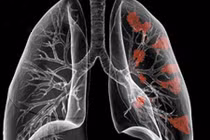Những điều không nên bỏ qua về ung thư phổi