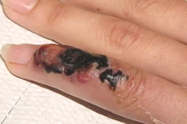 Hãi hùng bệnh than “tấn công” người ồ ạt