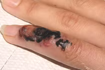 Hãi hùng bệnh than “tấn công” người ồ ạt