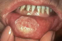 Dấu hiệu phát hiện ung thư môi sớm