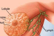 Hiểu lầm ngớ ngẩn về nguyên nhân ung thư vú