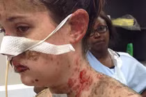 Khủng khiếp hotgirl biến dạng vì thuốc động kinh