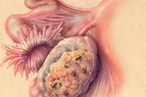 Con số đáng sợ về ung thư buồng trứng