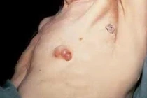 Hướng dẫn nam giới ngừa ung thư vú hiệu quả