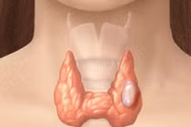 Thực phẩm kiêng dùng cho người ung thư tuyến giáp