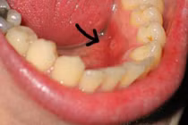 Dấu hiệu nhận biết ung thư miệng 