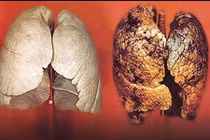 Dấu hiệu ung thư phổi ở người không hút thuốc