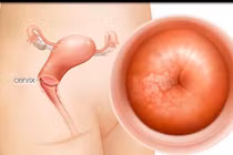 Cách phát hiện sớm bệnh ung thư tử cung