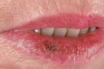 Nguyên nhân hàng đầu gây ung thư môi