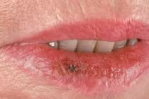 Nguyên nhân hàng đầu gây ung thư môi