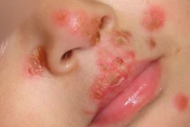 Top bệnh nguy hiểm lây rất dễ khi mẹ hôn môi con