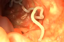 Ăn sashimi, rùng mình phát hiện ổ sán dây trong cơ thể