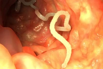 Ăn sashimi, rùng mình phát hiện ổ sán dây trong cơ thể