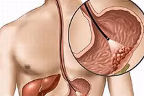 Sự nguy hiểm của bệnh ung thư dạ dày