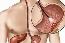 Sự nguy hiểm của bệnh ung thư dạ dày