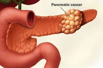 5 điều nên biết về ung thư tụy