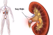 5 dấu hiệu bệnh thận nghiêm trọng hay bị bỏ qua