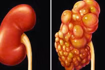 Cách dễ dàng ngăn ngừa ung thư thận