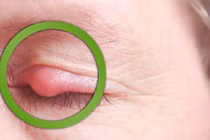 Mẹo dân gian trị lẹo mắt tại nhà nhanh khỏi nhất