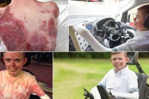 Cậu bé quấn băng 4h/ngày vì mắc bệnh da hiếm gặp