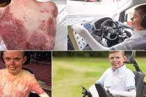 Cậu bé quấn băng 4h/ngày vì mắc bệnh da hiếm gặp