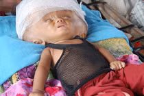 Kinh hoàng bé gái có sọ não căng phồng như cái thúng