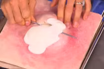 Tận mục kỹ thuật nặn mụn không để lại vết thâm