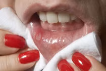 Mẹo trị rộp môi khó chịu chỉ sau 1 đêm