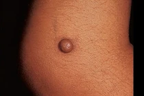 Lý do phụ nữ dễ vượt qua u da ác tính