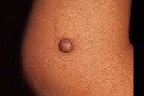 Lý do phụ nữ dễ vượt qua u da ác tính