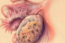 Cận cảnh sức tàn phá của ung thư buồng trứng