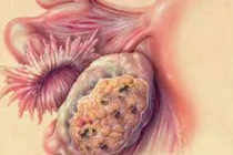 Cận cảnh sức tàn phá của ung thư buồng trứng