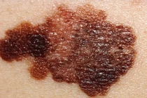 Hình ảnh chi tiết giúp nhận dạng ung thư da