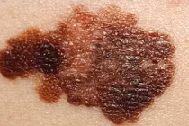 Hình ảnh chi tiết giúp nhận dạng ung thư da