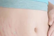 Làm mờ vết rạn da chỉ với 10 phút massage mỗi ngày