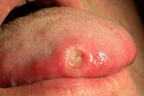 Tận mục sức tàn phá khủng khiếp của ung thư lưỡi