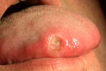 Tận mục sức tàn phá khủng khiếp của ung thư lưỡi