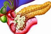 Cách ăn uống ngăn ngừa ung thư tuyến tụy