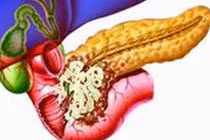 Cách ăn uống ngăn ngừa ung thư tuyến tụy