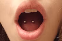 Tác hại khủng khiếp của việc xỏ khuyên lưỡi